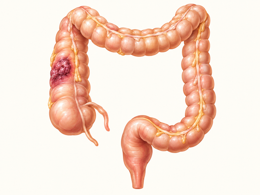 AI educational illustration: Newly Diagnosed Colon Cancer