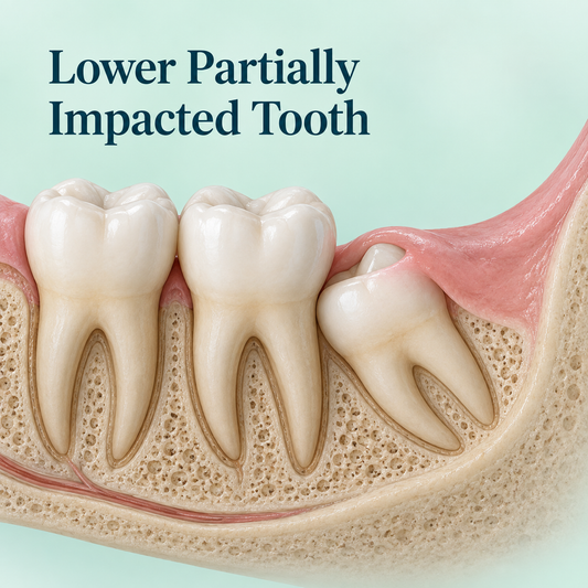 Lower Partially Impacted Tooth. Educational illustration.