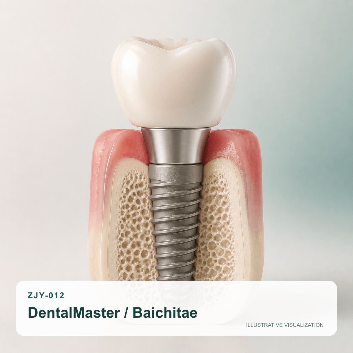 DentalMaster Baichitae dental implant system illustrative visualization