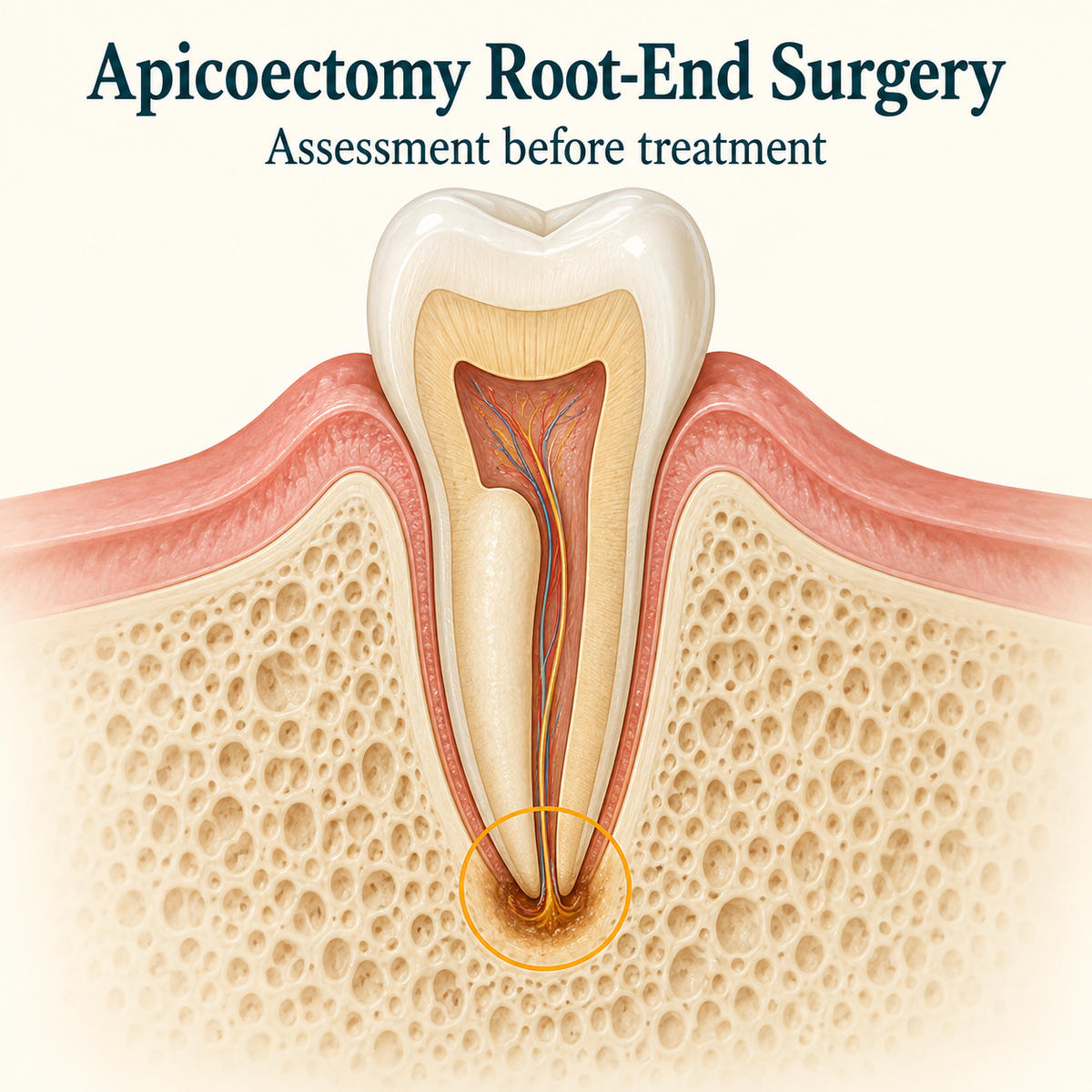 Root-end surgery targets the apex of a retainable tooth. Educational illustration.