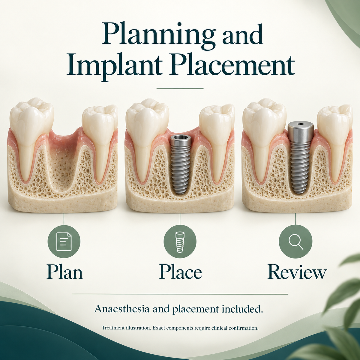 Axiom implant treatment planning, placement and review. Conceptual illustration.
