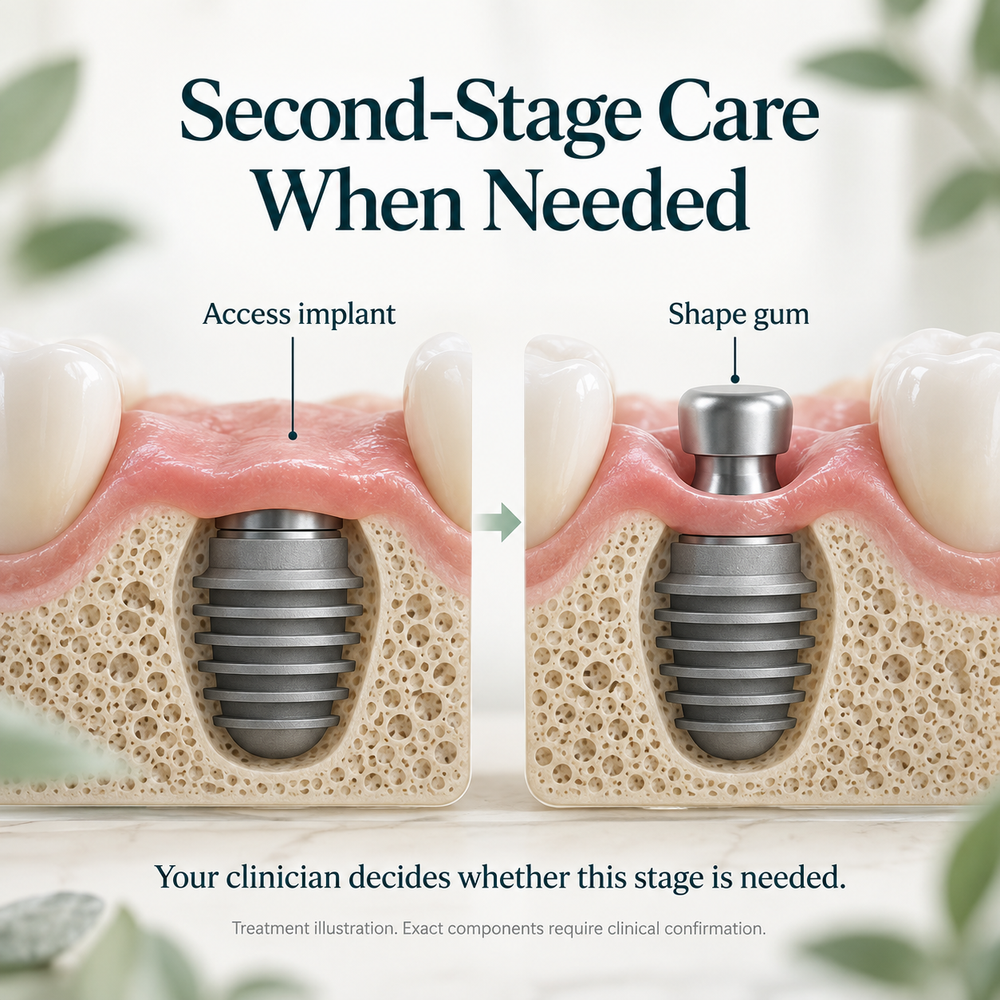 Educational Bicon treatment illustration. Exact components require clinical confirmation.