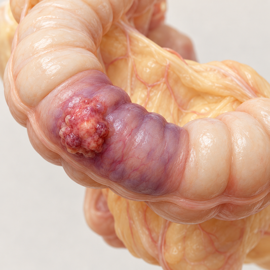 AI-generated educational illustration: Sometimes bowel is involved. Not a real patient, scan or identified medical team.