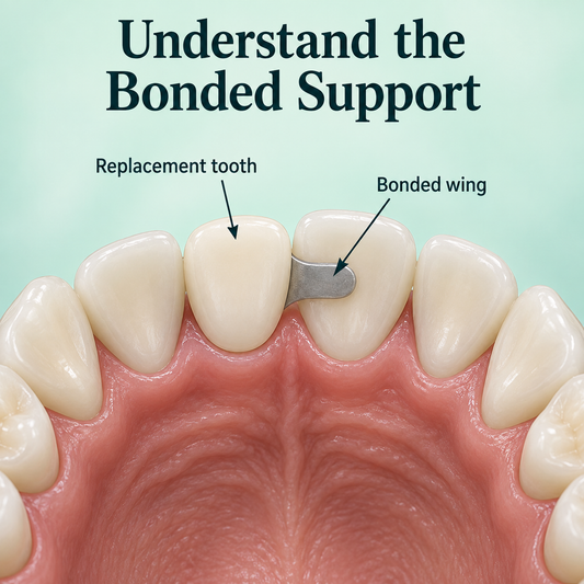 A wing bonds to the back of a supporting tooth. Educational illustration.