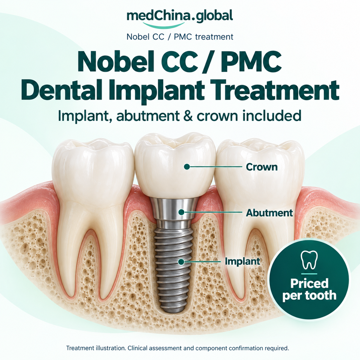 Nobel CC / PMC treatment: overview. Educational illustration; clinical assessment and exact components require confirmation.