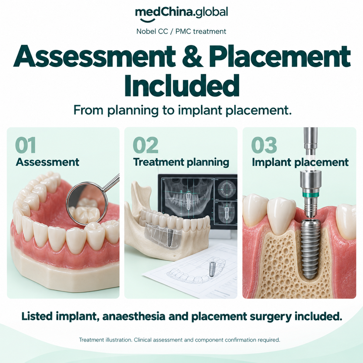 Nobel CC / PMC treatment: placement. Educational illustration; clinical assessment and exact components require confirmation.