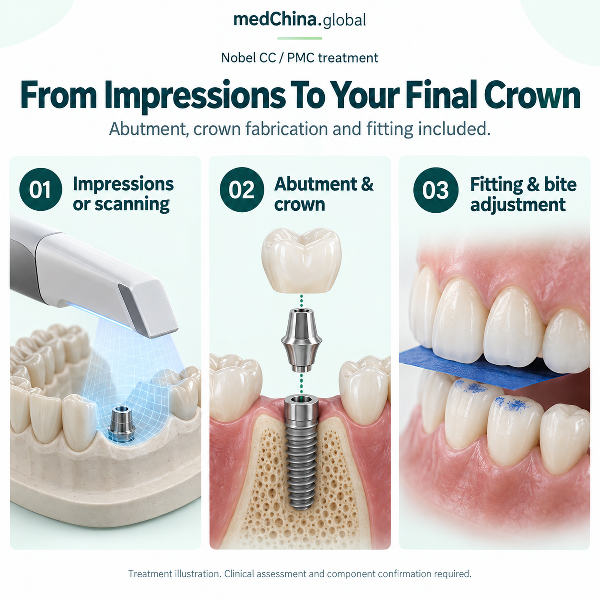 Nobel CC / PMC treatment: restoration. Educational illustration; clinical assessment and exact components require confirmation.
