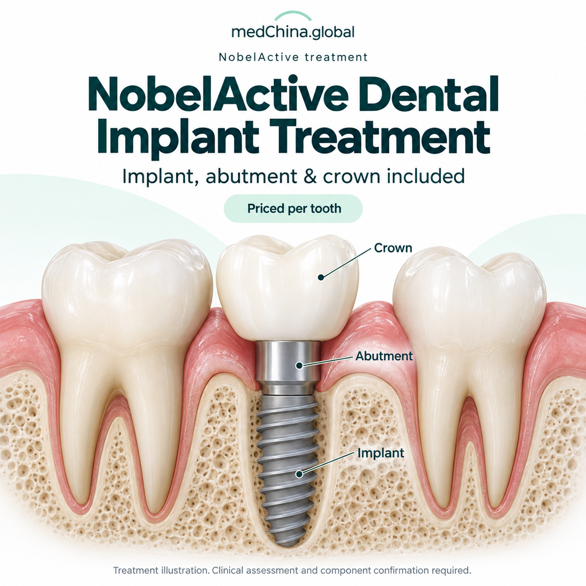 NobelActive treatment: service overview. Generic treatment illustration; clinical assessment and component confirmation required.