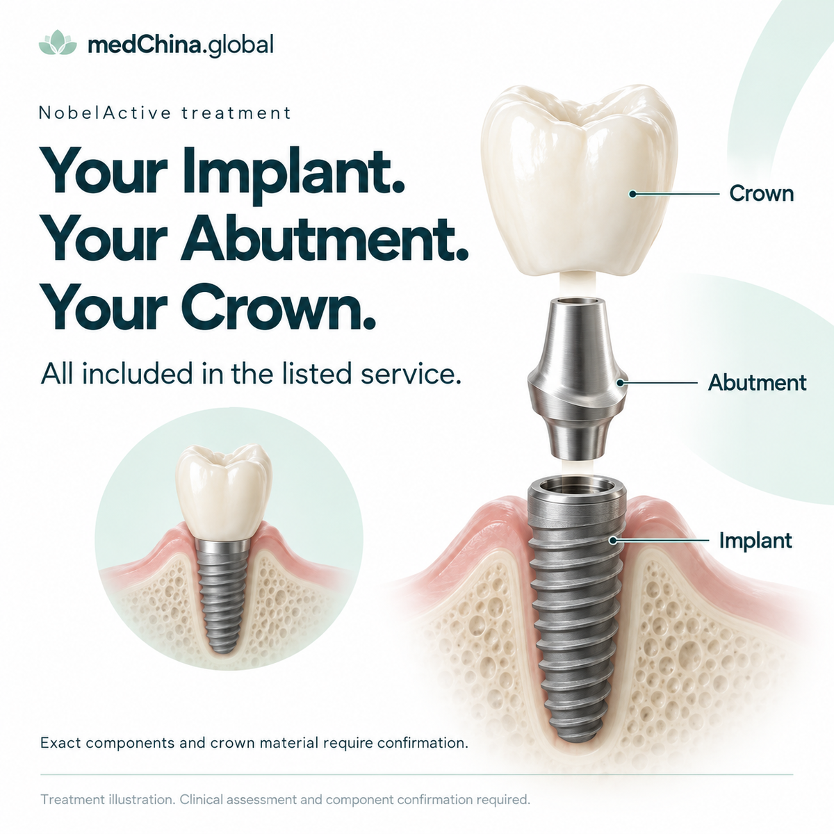 NobelActive treatment: three components. Generic treatment illustration; clinical assessment and component confirmation required.