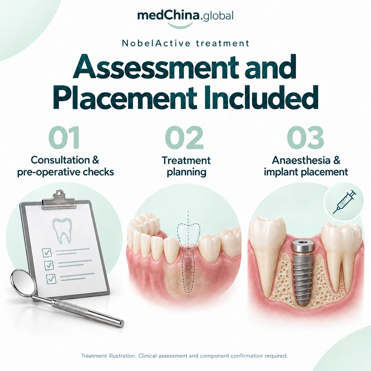 NobelActive treatment: assessment placement. Generic treatment illustration; clinical assessment and component confirmation required.