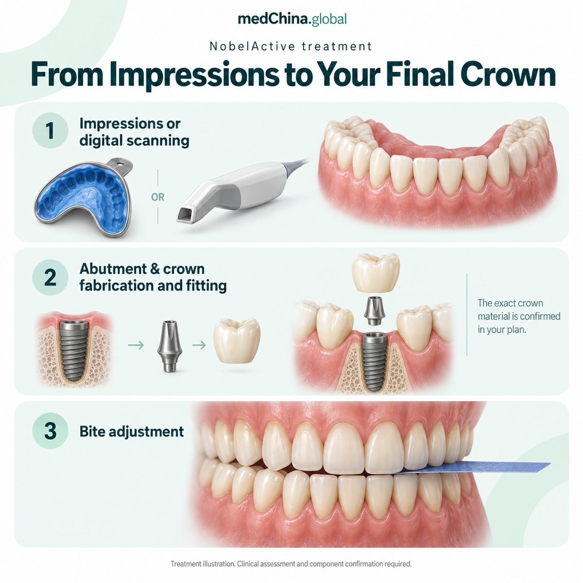 NobelActive treatment: restoration. Generic treatment illustration; clinical assessment and component confirmation required.