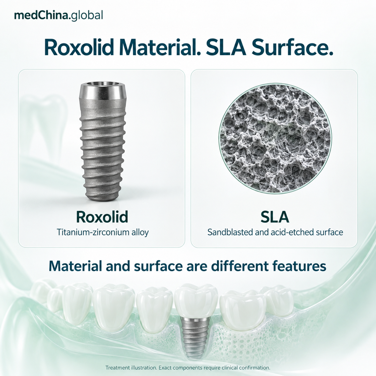 Roxolid SLA material-surface: educational treatment illustration; exact components require clinical confirmation.