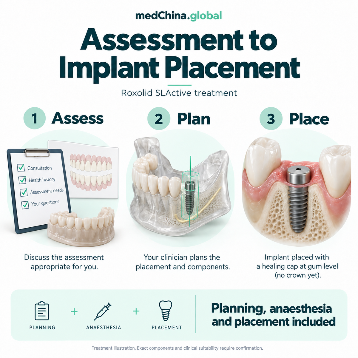 Roxolid SLActive treatment: placement. Educational illustration; exact components require clinical confirmation.
