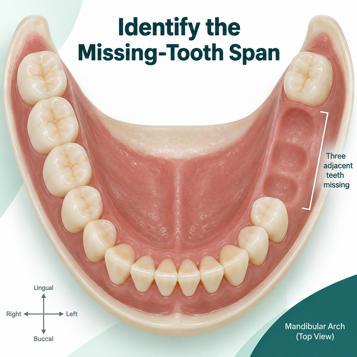 Adjacent missing teeth define the span assessed for a bridge. Educational illustration.