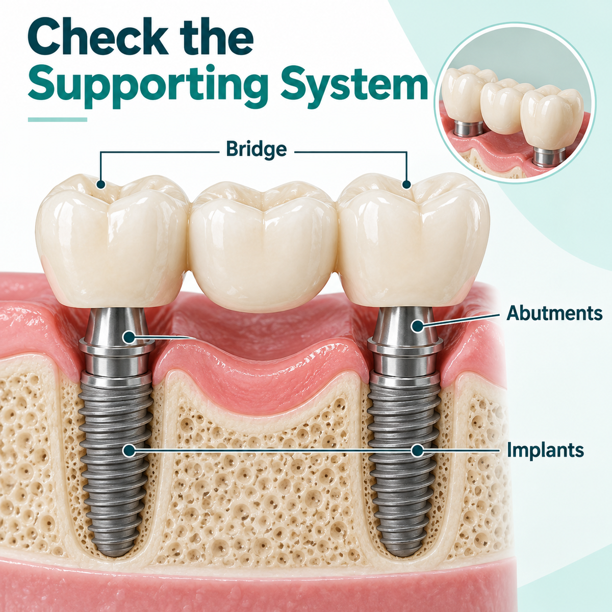 Two implants support a connected bridge in an illustrative model. Educational illustration.