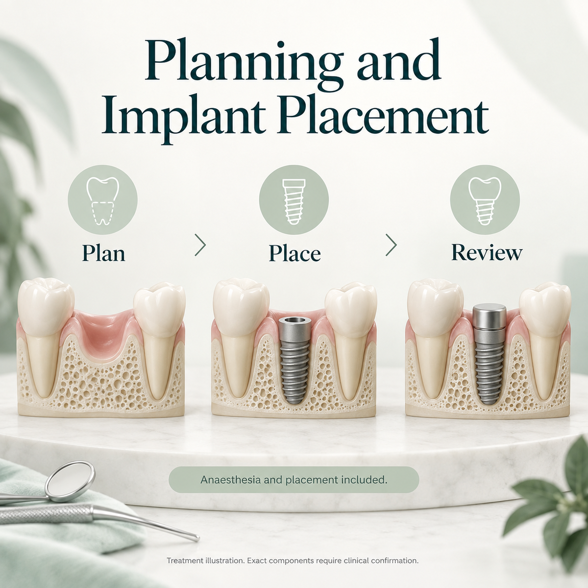 Ti SLA treatment illustration: placement. Exact components require clinical confirmation.