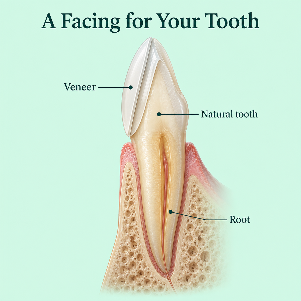 Cross-section shows veneer on the front surface of a retained incisor. Educational illustration.
